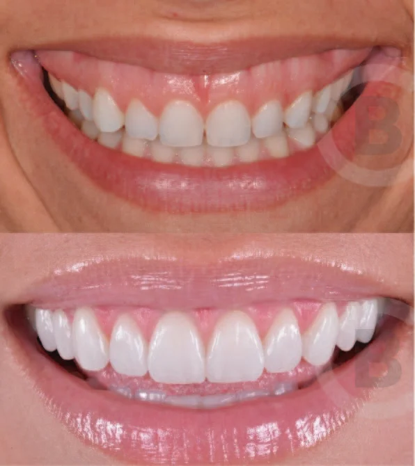 Tratamiento de Sonrisa Gingival - Bioestimulación